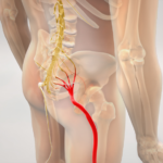 lombosciatalgia ozonoterapia